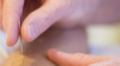 Things you should know before trying acupuncture