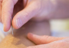 Things you should know before trying acupuncture