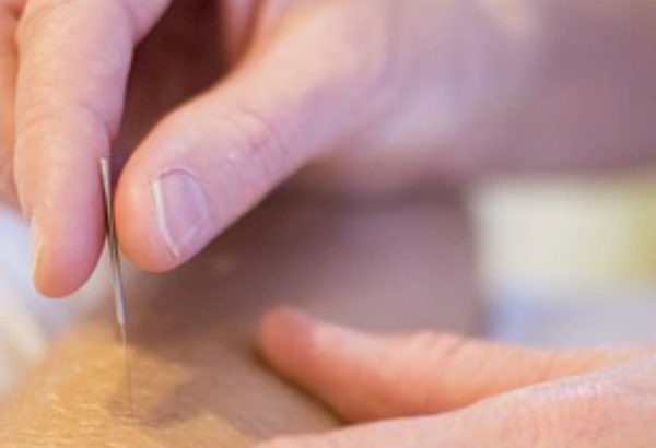 Things you should know before trying acupuncture